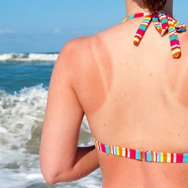 ปรนนิบัติผิวง่ายๆ หลังแดดเผา