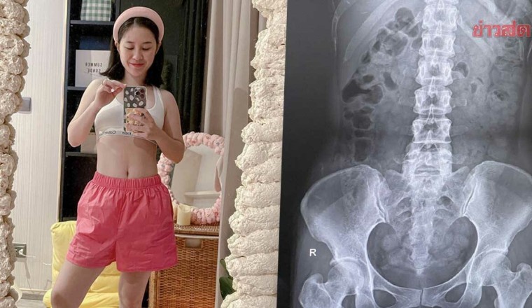 ตุ๊กตา เข็ด อั้นอึจนป่วย ‘โรคขี้เต็มท้อง’ แนะรีบพบแพทย์หาหมอ อย่าหายาทานเอง