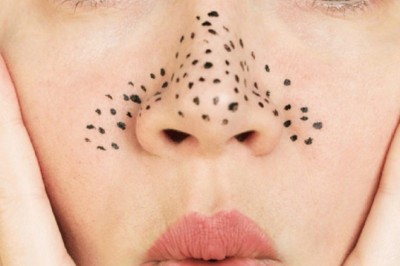 สูตรขจัดสิวหัวดำ