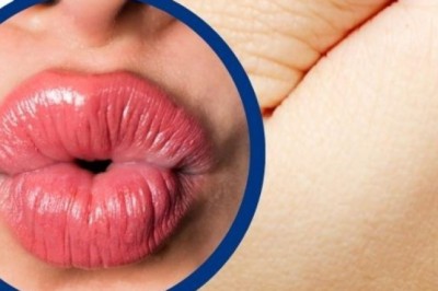 หอมหรือจูบ ไม่ได้ทำให้เกิดโรคฟันผุ